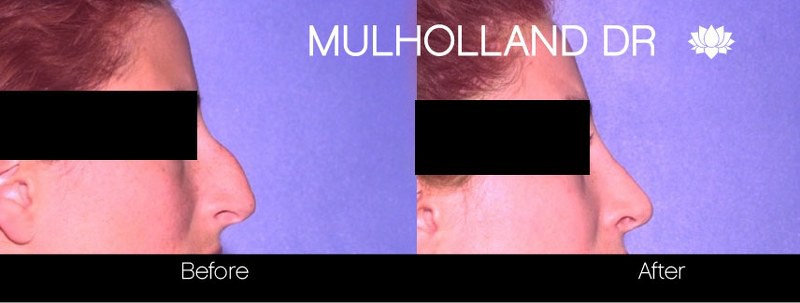 Rhinoplasty - Before and After Gallery – Photo 28