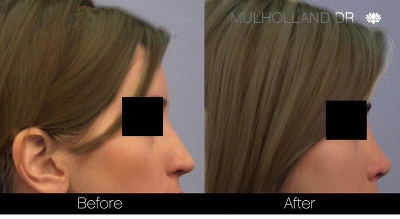 Rhinoplasty - Before and After Gallery – Photo 29