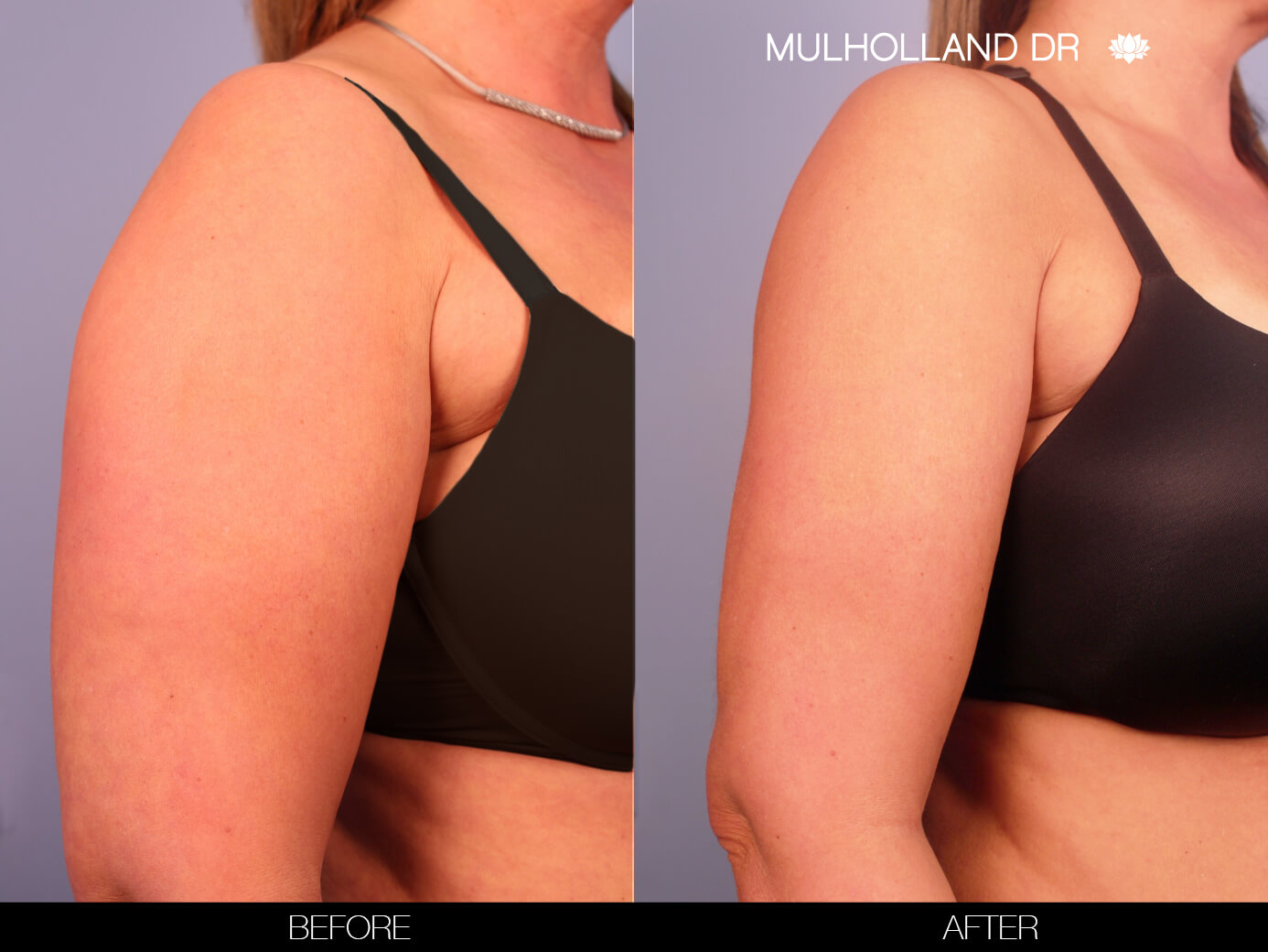 Arm Lift - Before and After Gallery – Photo 2