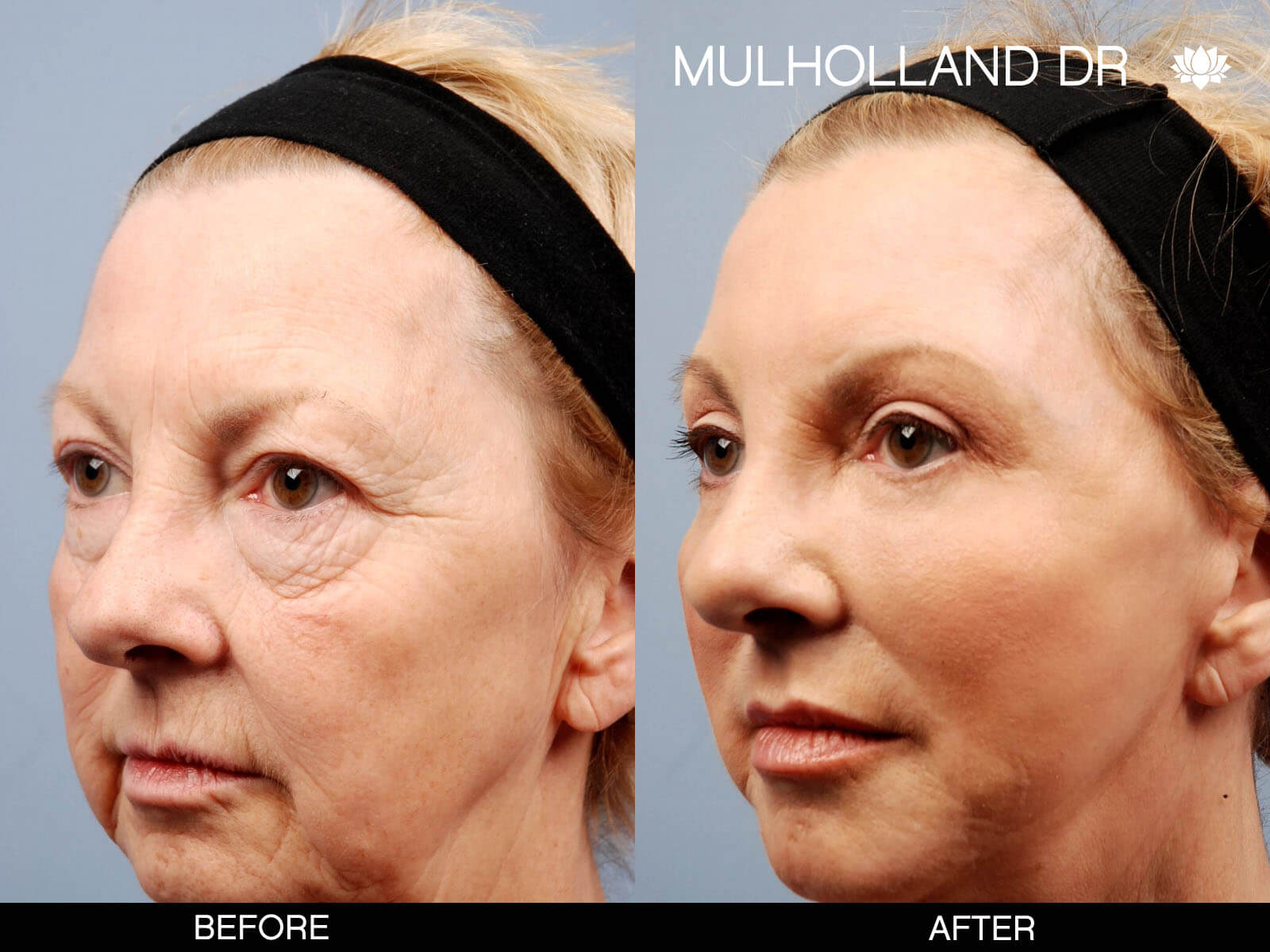 Facelift - Before and After Gallery – Photo 2