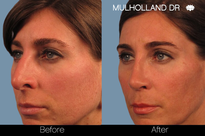 Rhinoplasty - Before and After Gallery – Photo 2