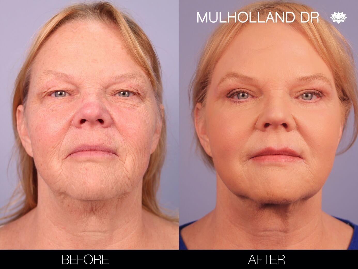 ThreadLift - Before and After Gallery – Photo 1