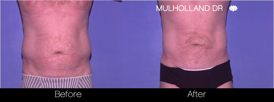 Male Liposuction - Before and After Gallery – Photo 1