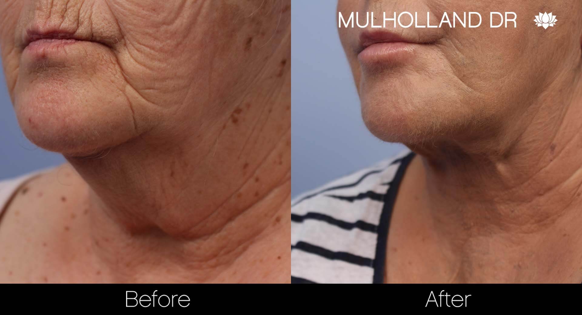 Facelift - Before and After Gallery – Photo 30