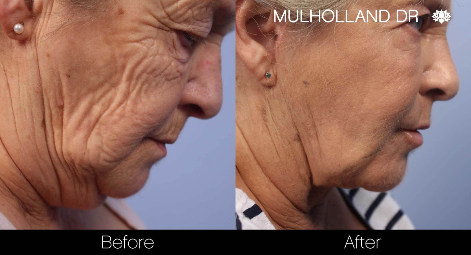 Facelift - Before and After Gallery – Photo 31
