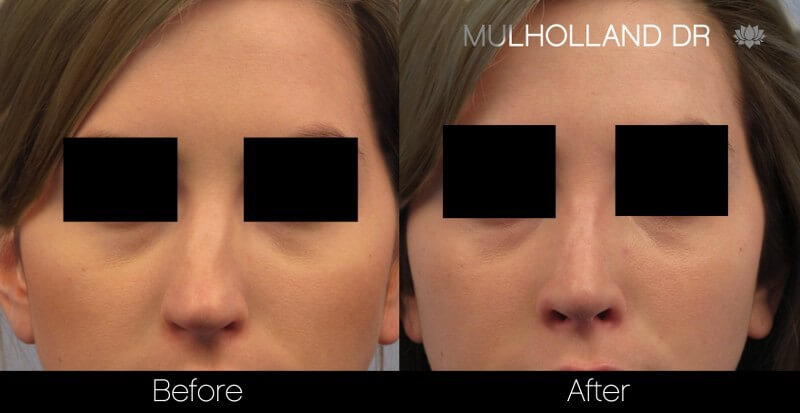 Rhinoplasty - Before and After Gallery – Photo 31