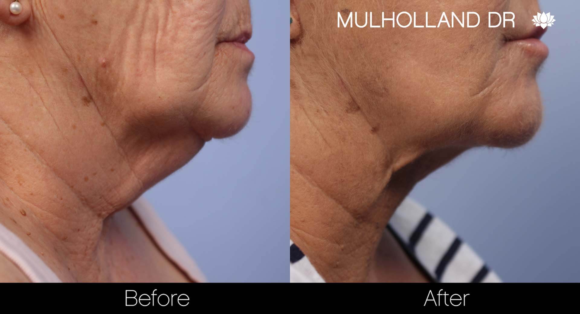 Facelift - Before and After Gallery – Photo 32