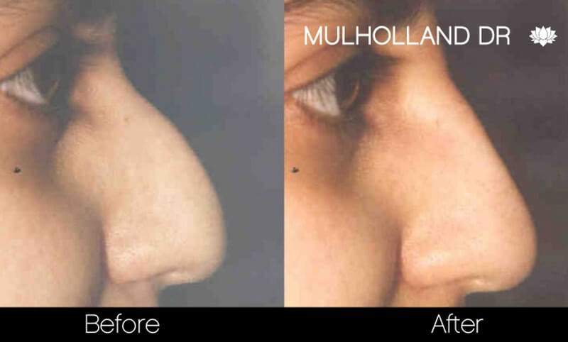 Rhinoplasty - Before and After Gallery – Photo 32