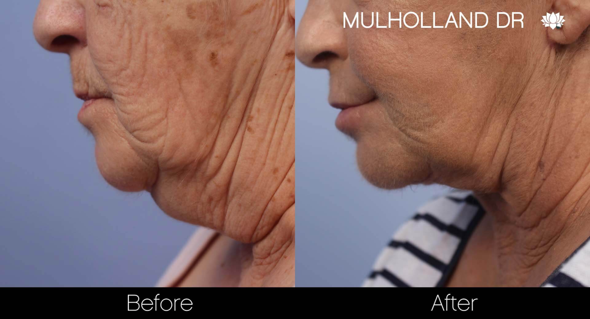 Facelift - Before and After Gallery – Photo 33