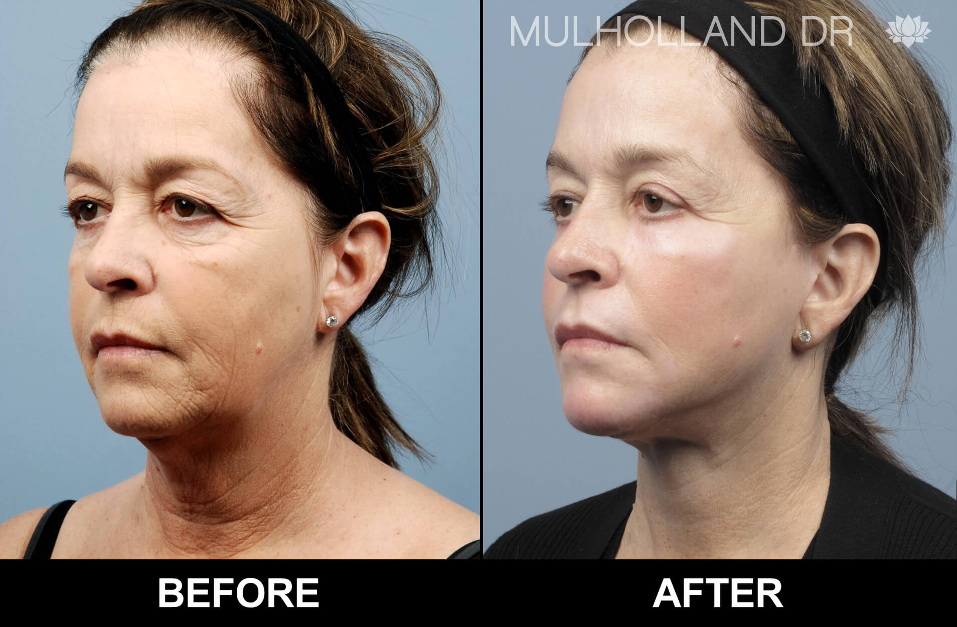Facelift - Before and After Gallery – Photo 35