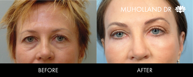 ThreadLift - Before and After Gallery – Photo 33
