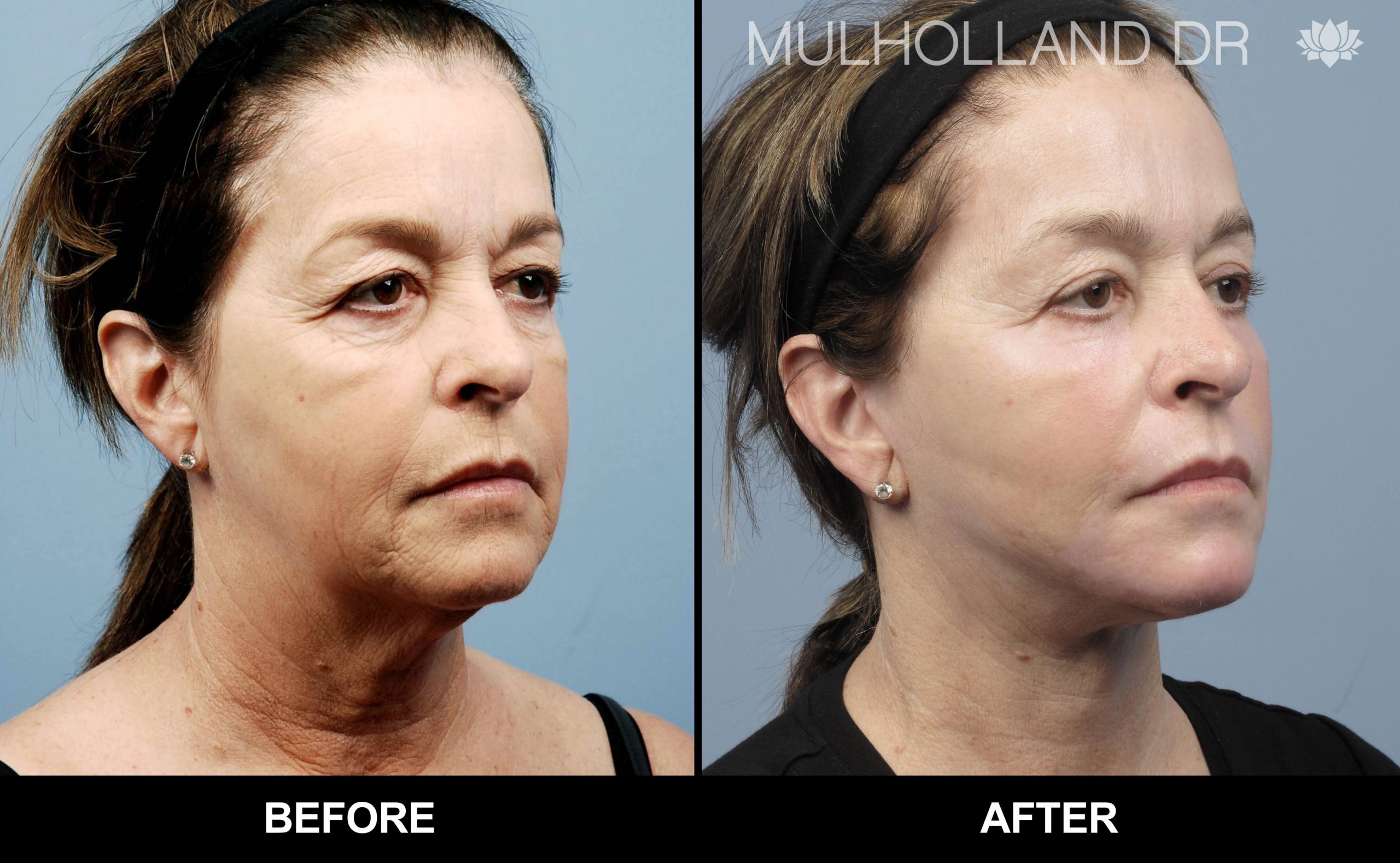 Facelift - Before and After Gallery – Photo 36