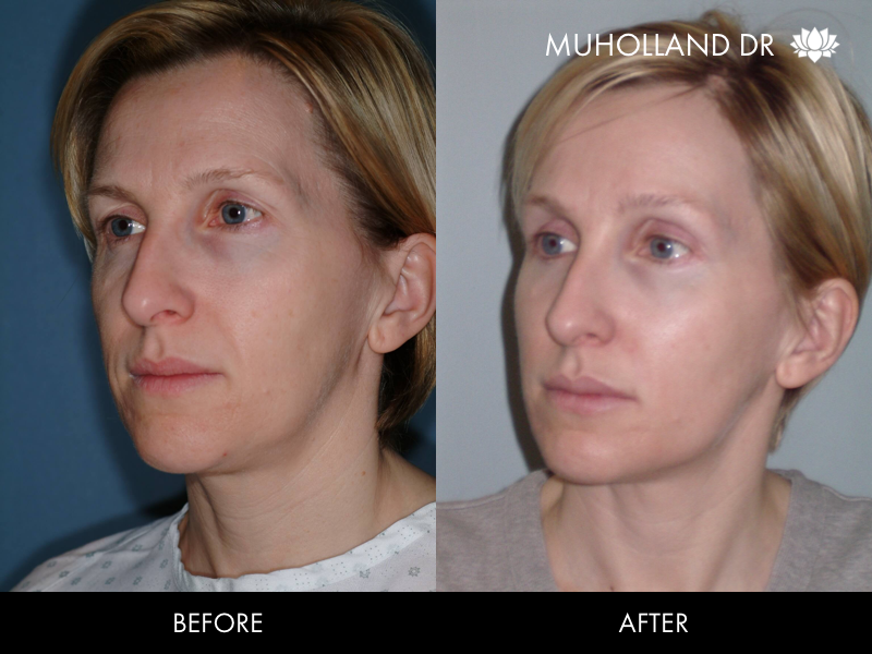 ThreadLift - Before and After Gallery – Photo 34