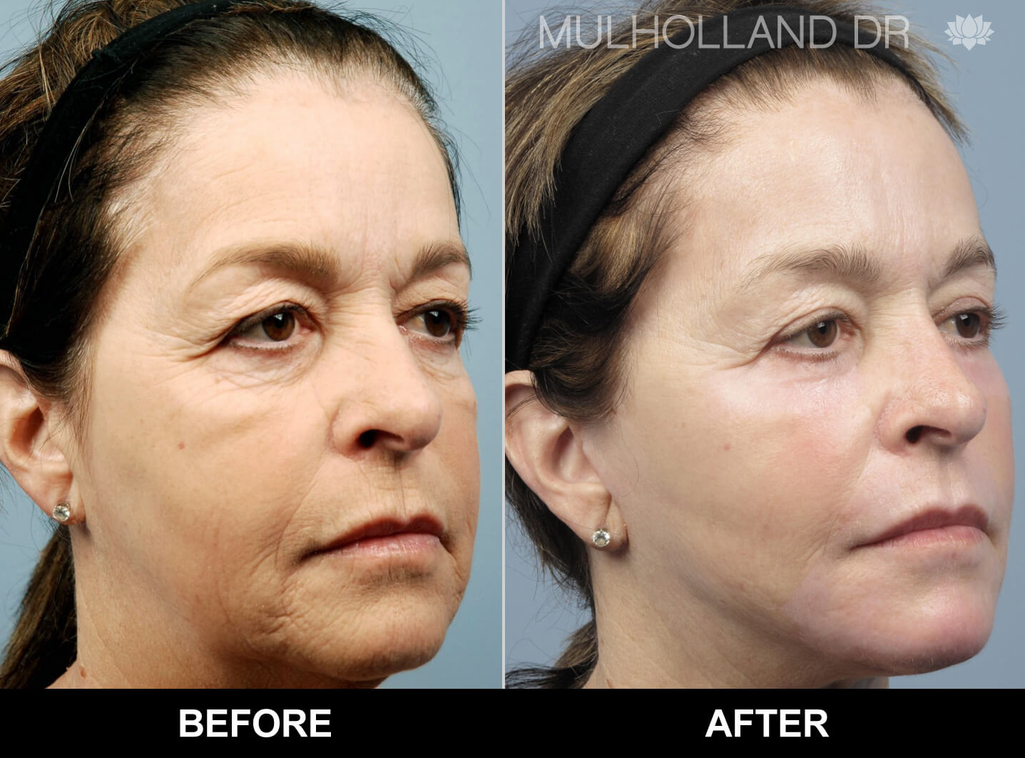 Facelift - Before and After Gallery – Photo 38