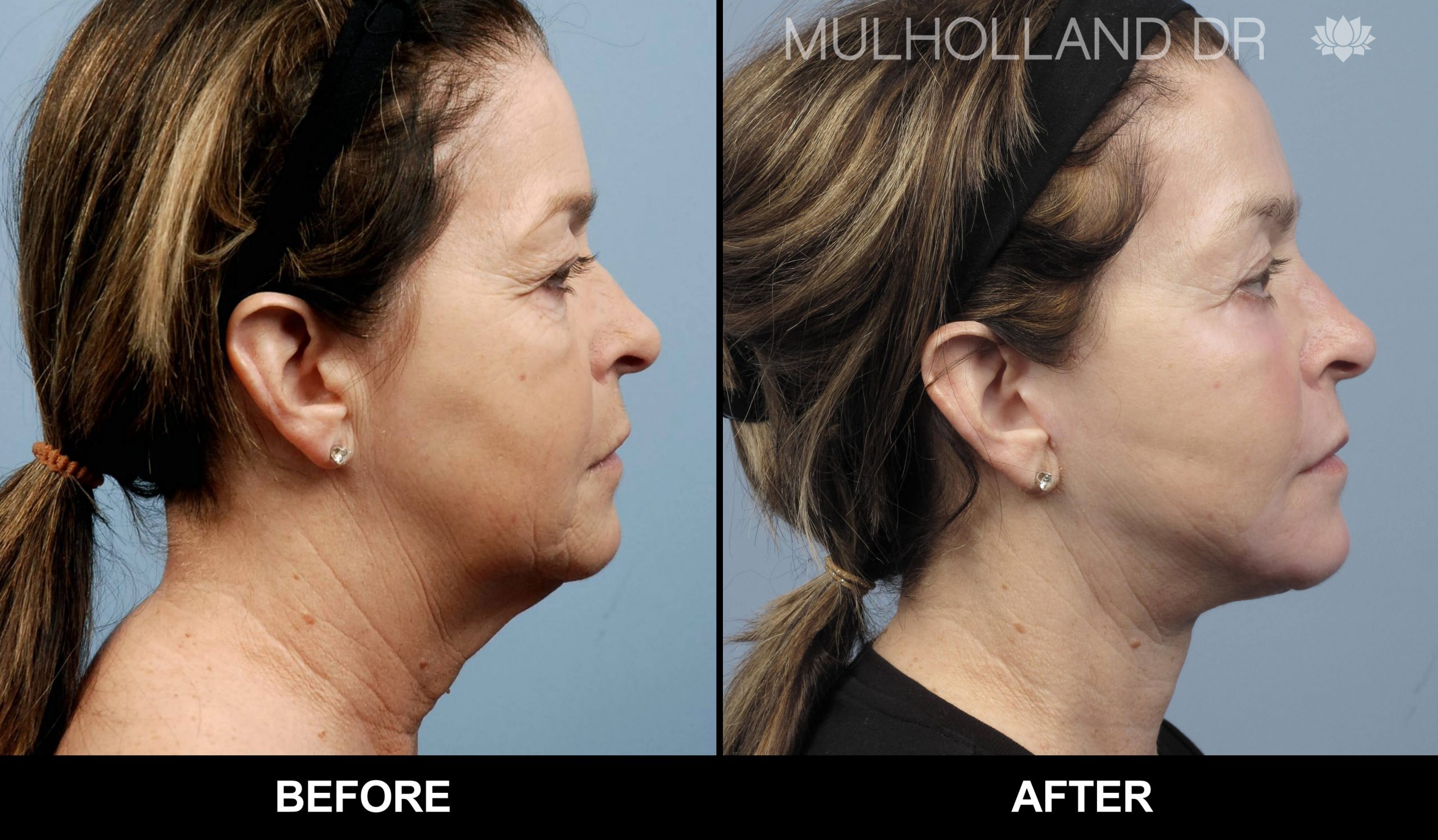 Facelift - Before and After Gallery – Photo 39