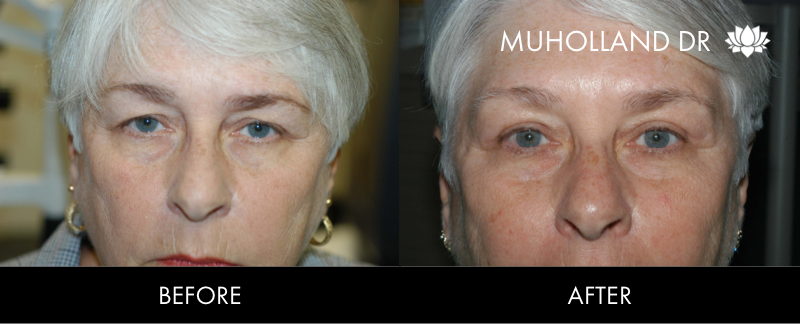 ThreadLift - Before and After Gallery – Photo 37