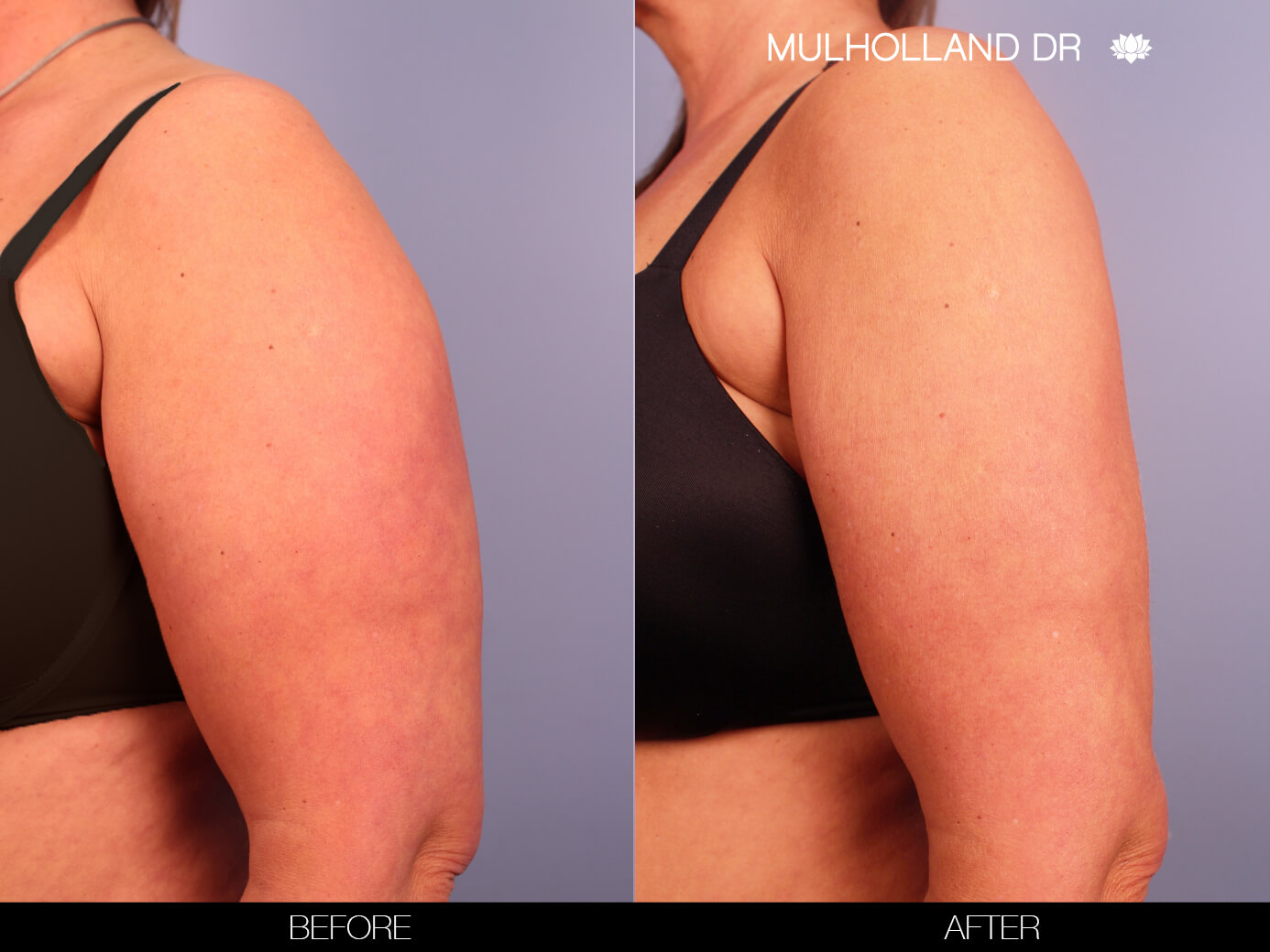 Arm Lift - Before and After Gallery – Photo 3