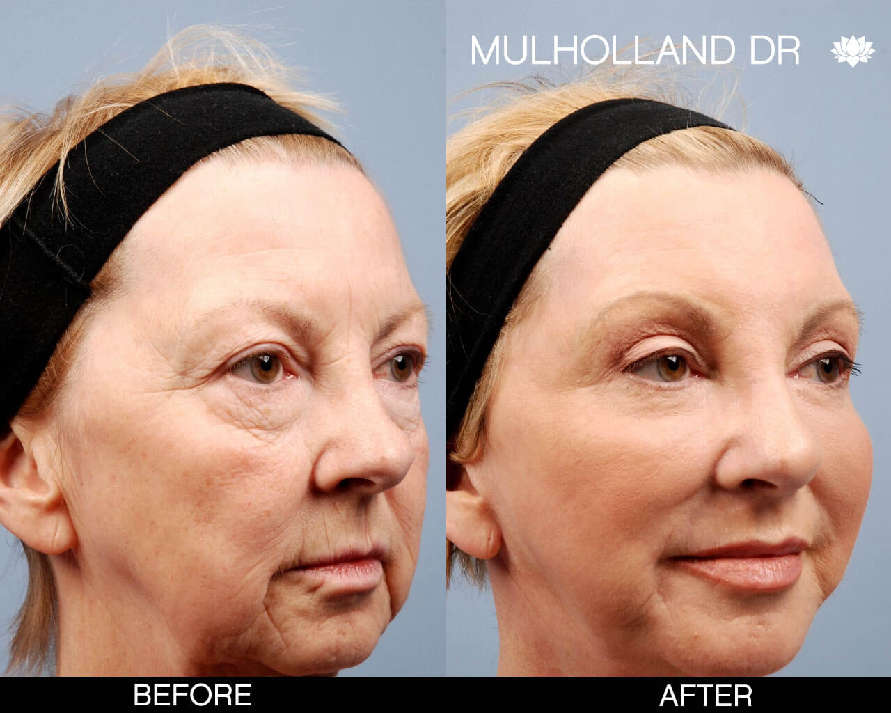 Facelift - Before and After Gallery – Photo 3