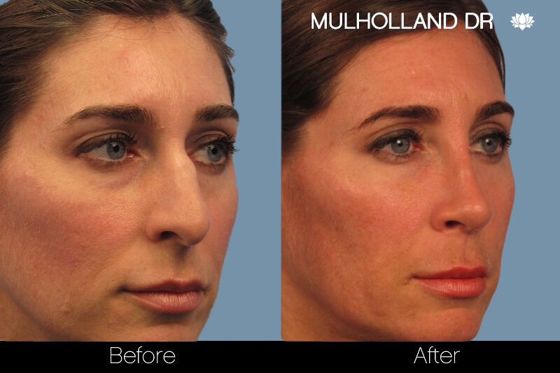 Rhinoplasty - Before and After Gallery – Photo 3
