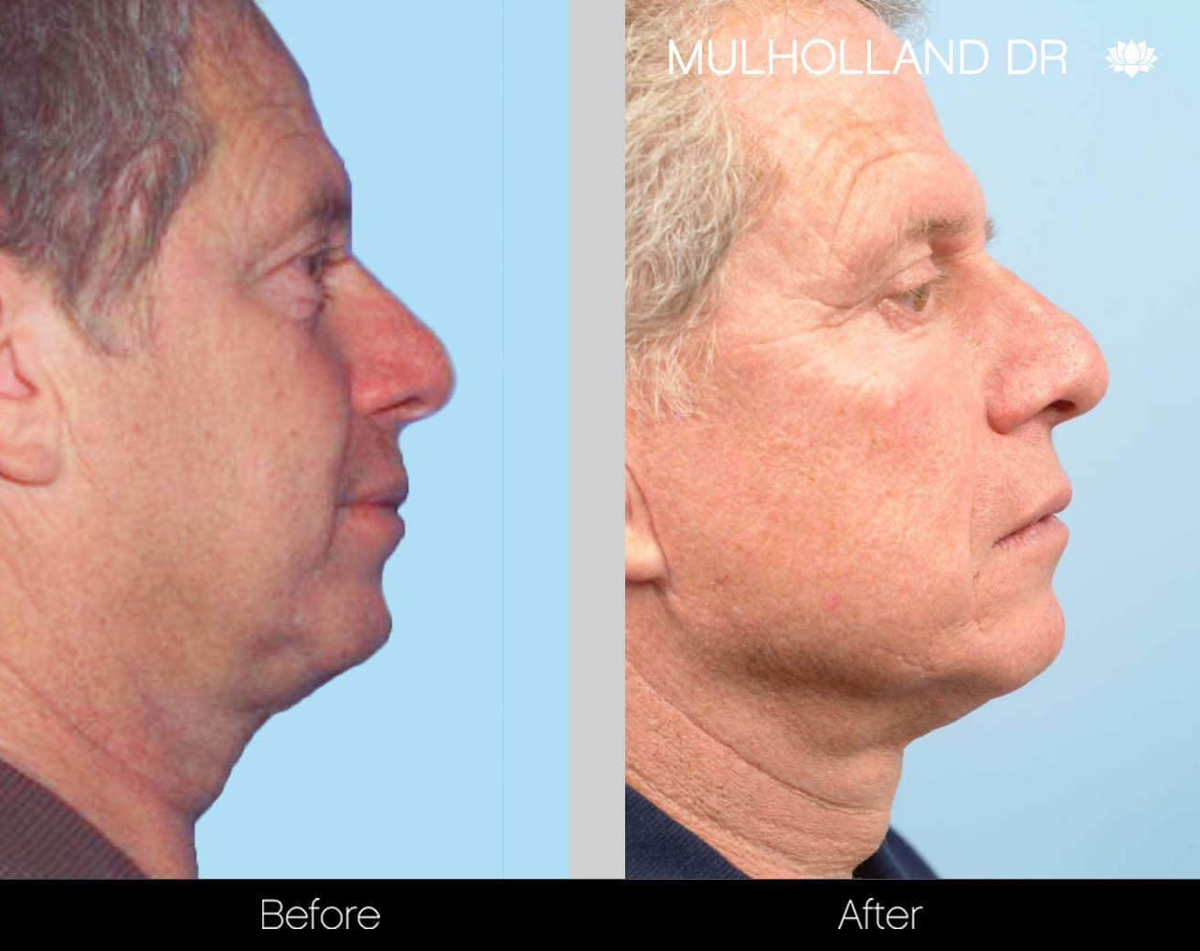 Facelift - Before and After Gallery – Photo 46