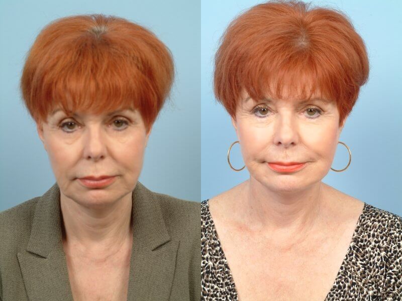 ThreadLift - Before and After Gallery – Photo 43