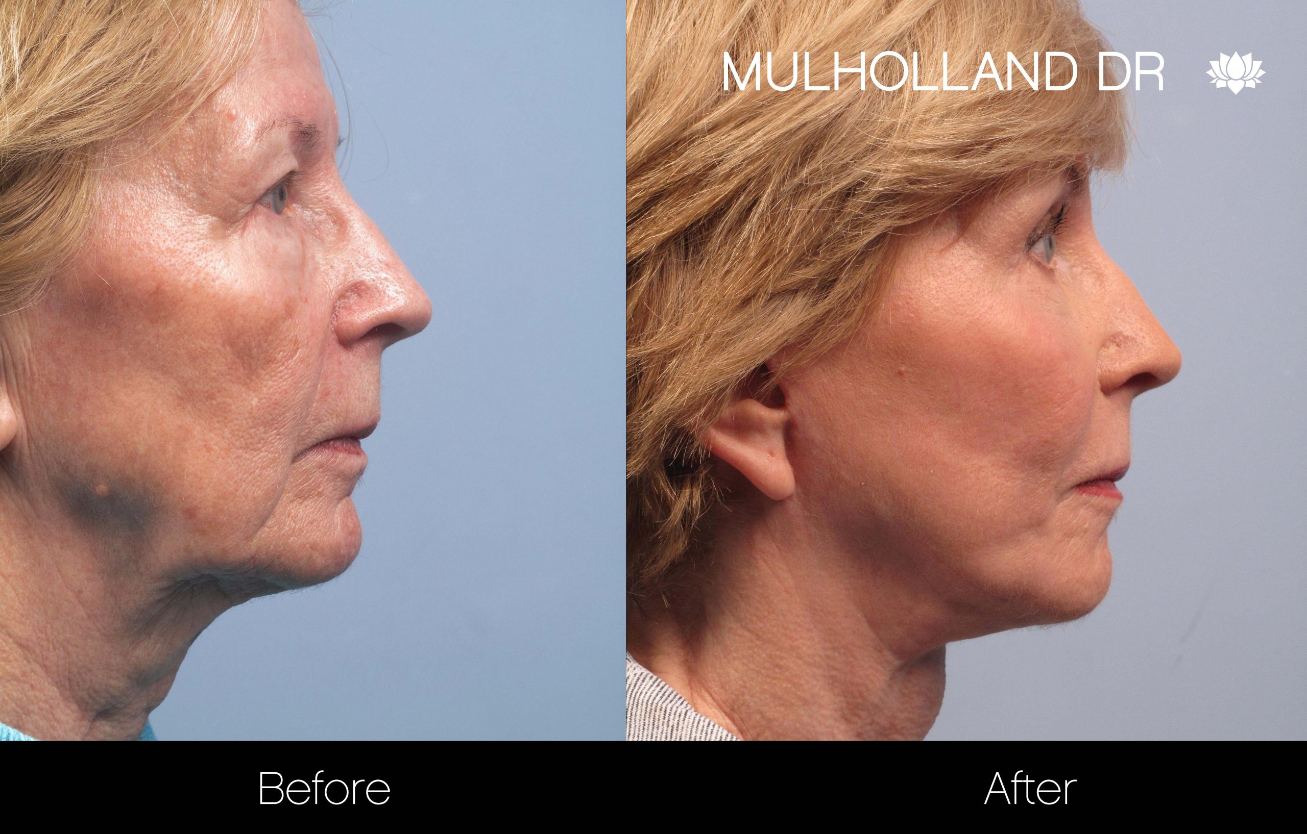 Facelift - Before and After Gallery – Photo 49