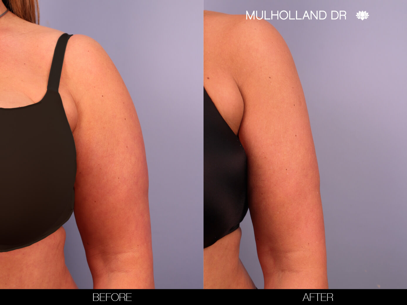 Arm Lift - Before and After Gallery – Photo 4