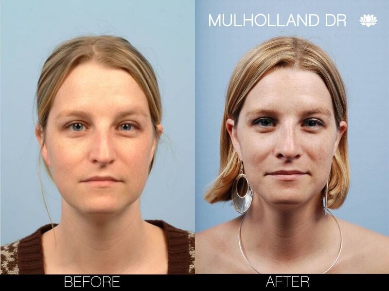 Rhinoplasty - Before and After Gallery – Photo 4