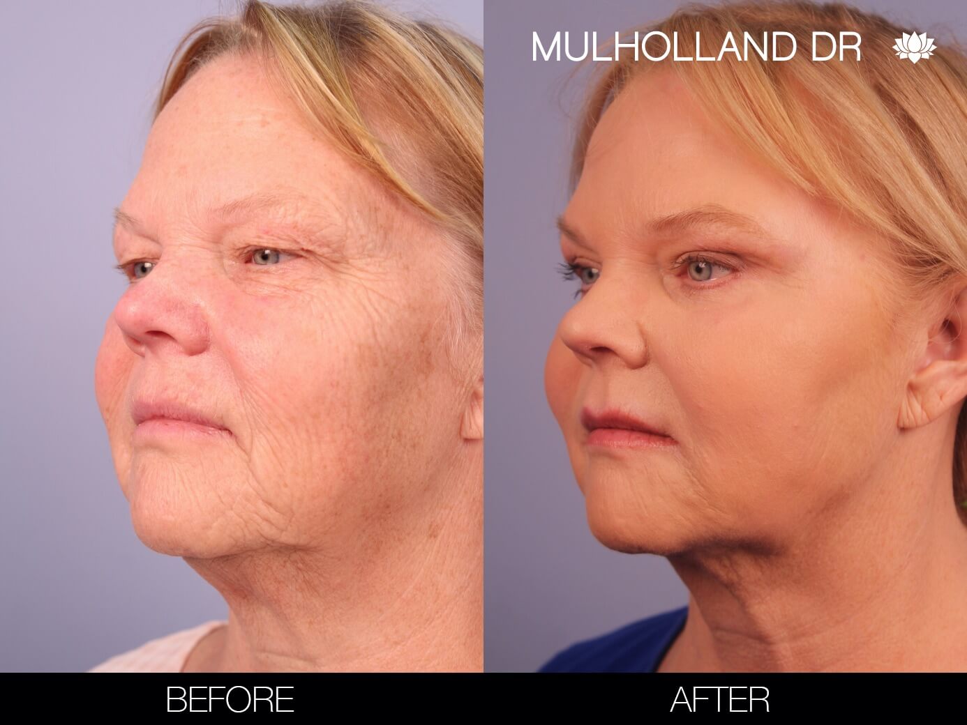 ThreadLift - Before and After Gallery – Photo 3