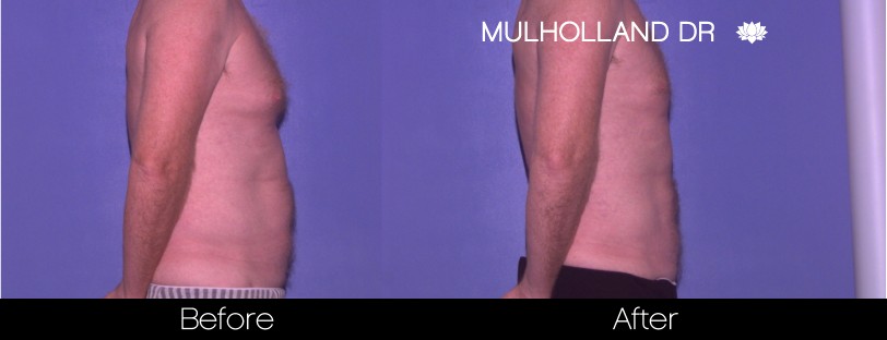 Male Liposuction - Before and After Gallery – Photo 3