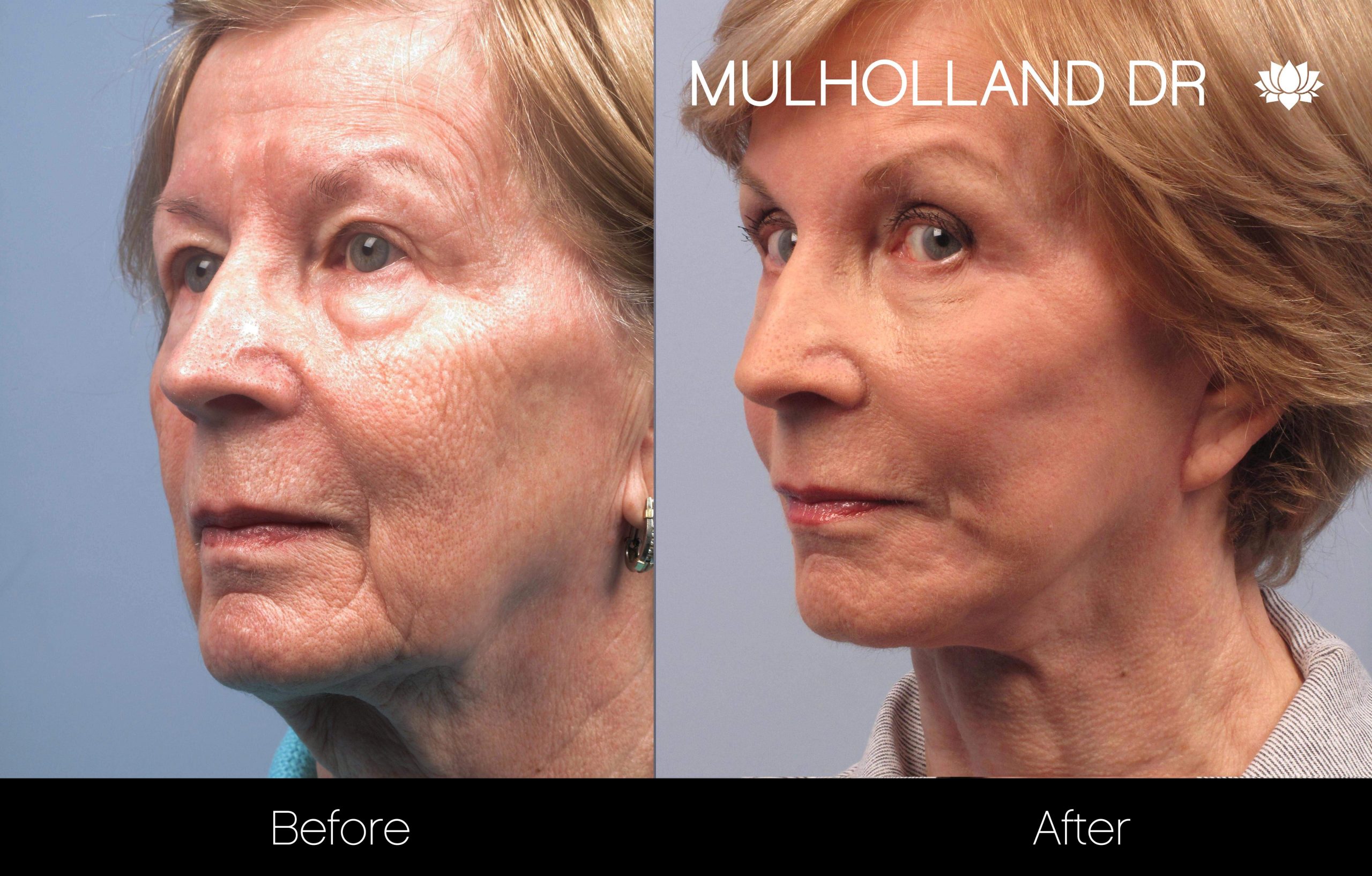 Facelift - Before and After Gallery – Photo 50