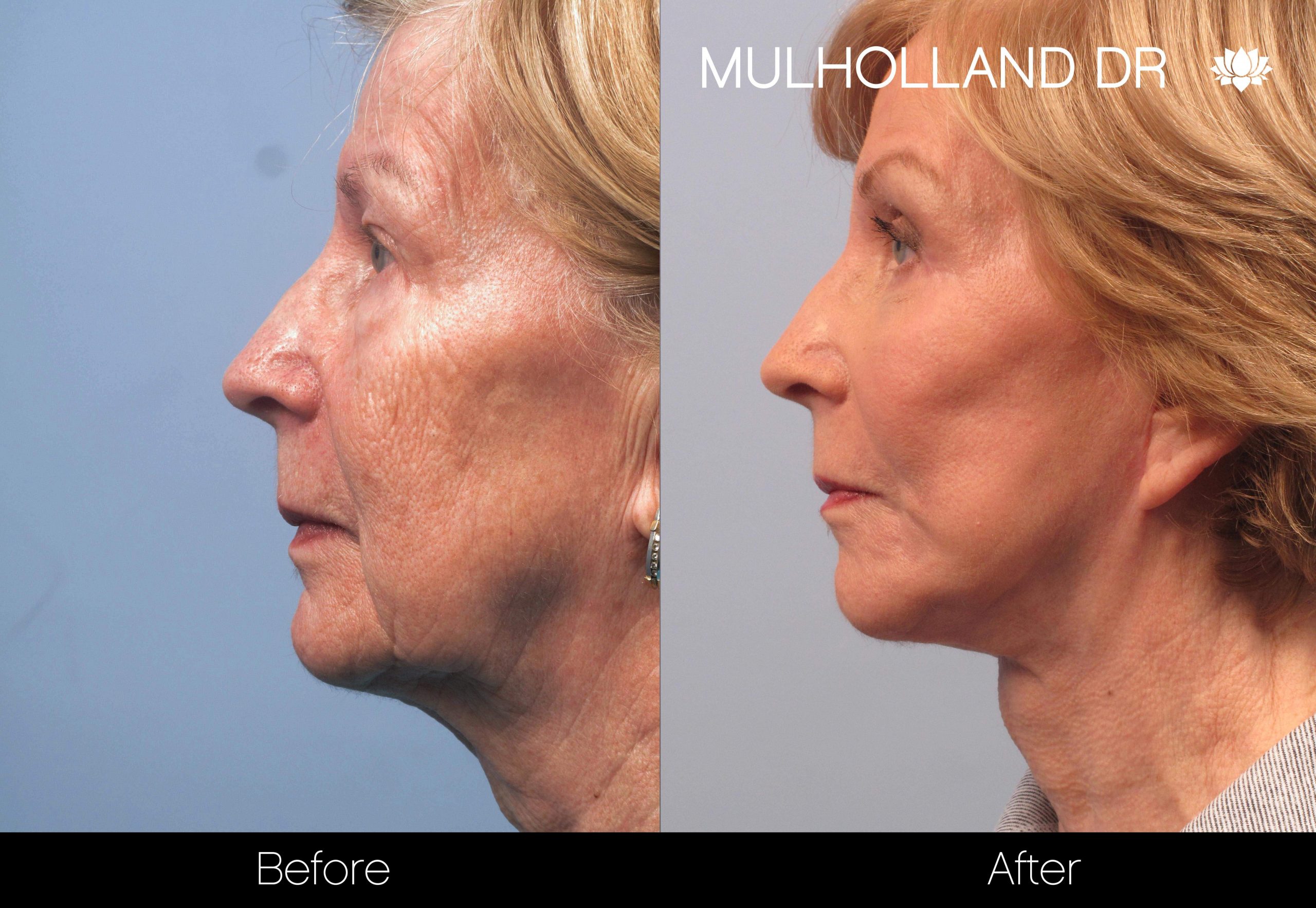 Facelift - Before and After Gallery – Photo 51
