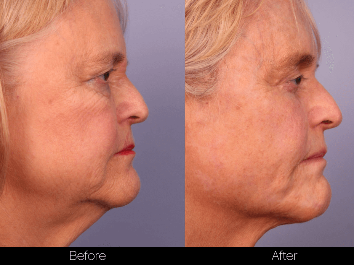 ThreadLift - Before and After Gallery – Photo 49