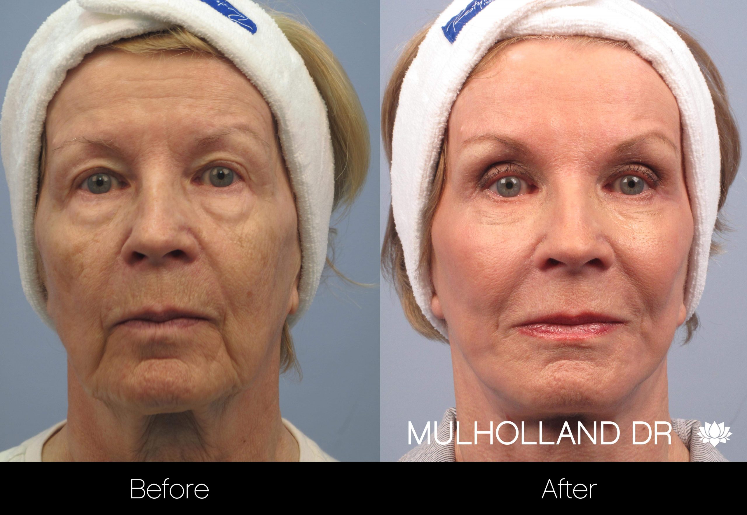 Facelift - Before and After Gallery – Photo 52