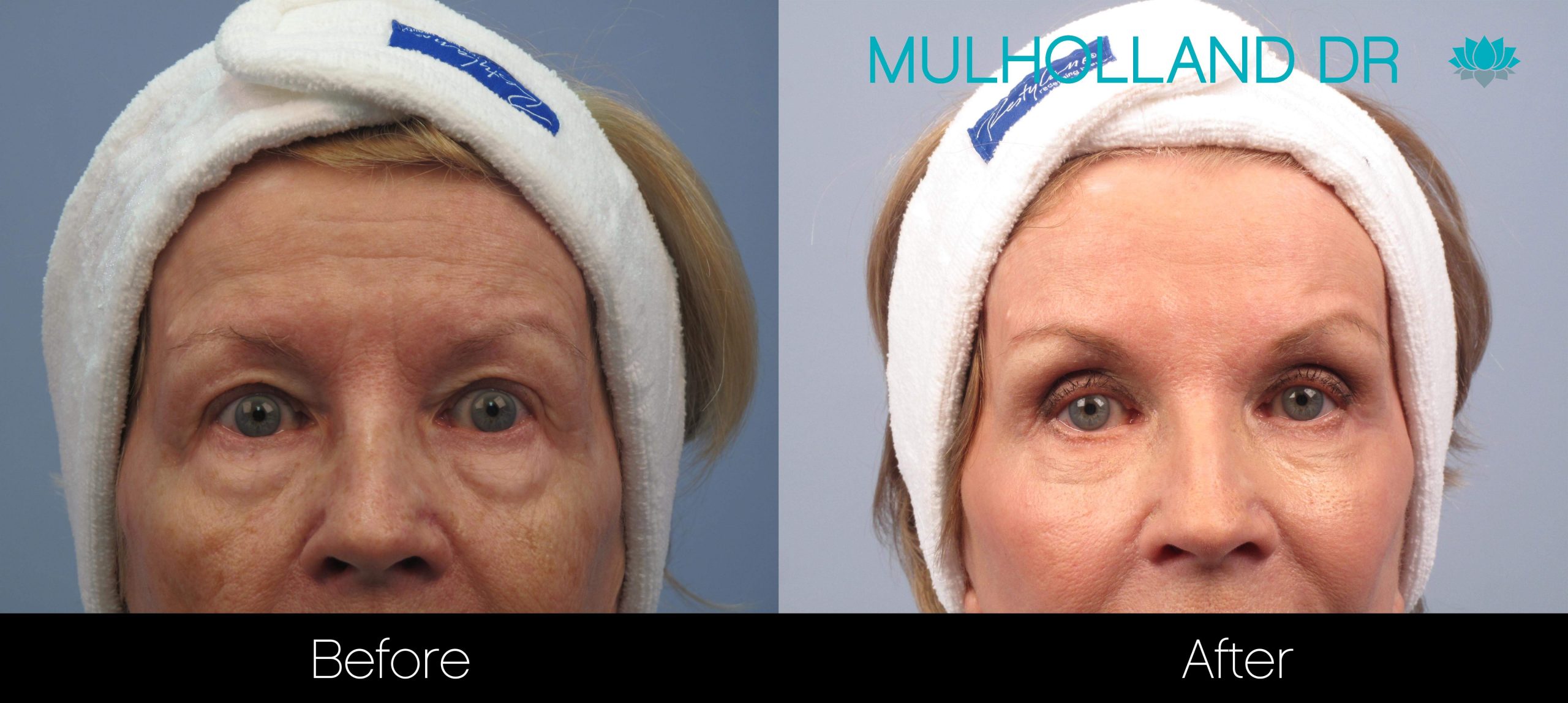 Facelift - Before and After Gallery – Photo 53
