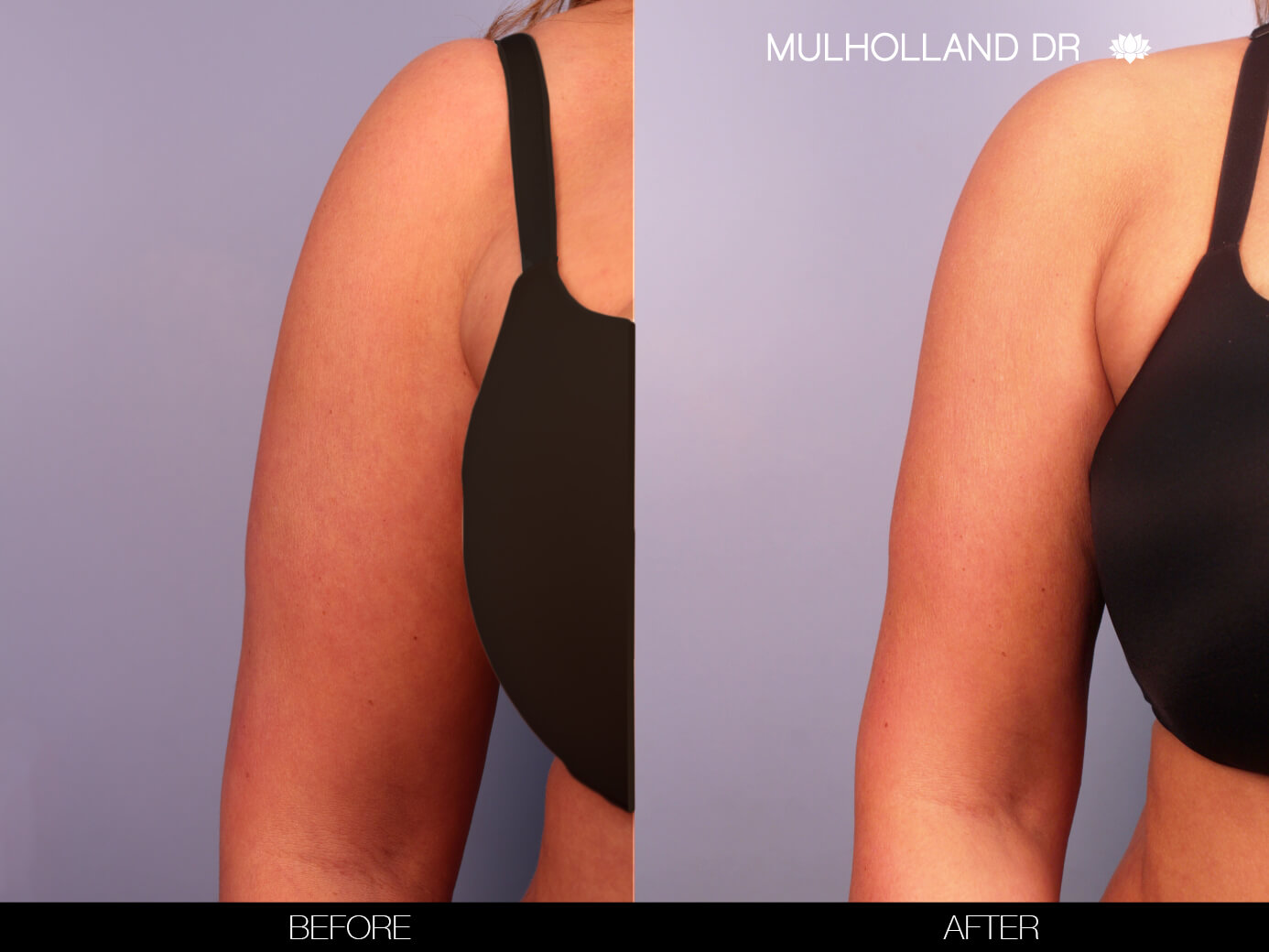 Arm Lift - Before and After Gallery – Photo 5