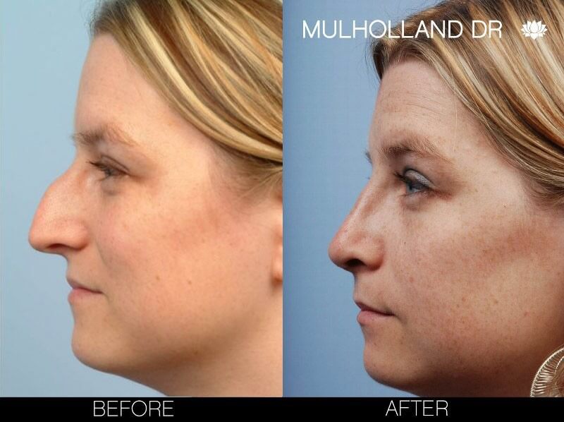 Rhinoplasty - Before and After Gallery – Photo 5