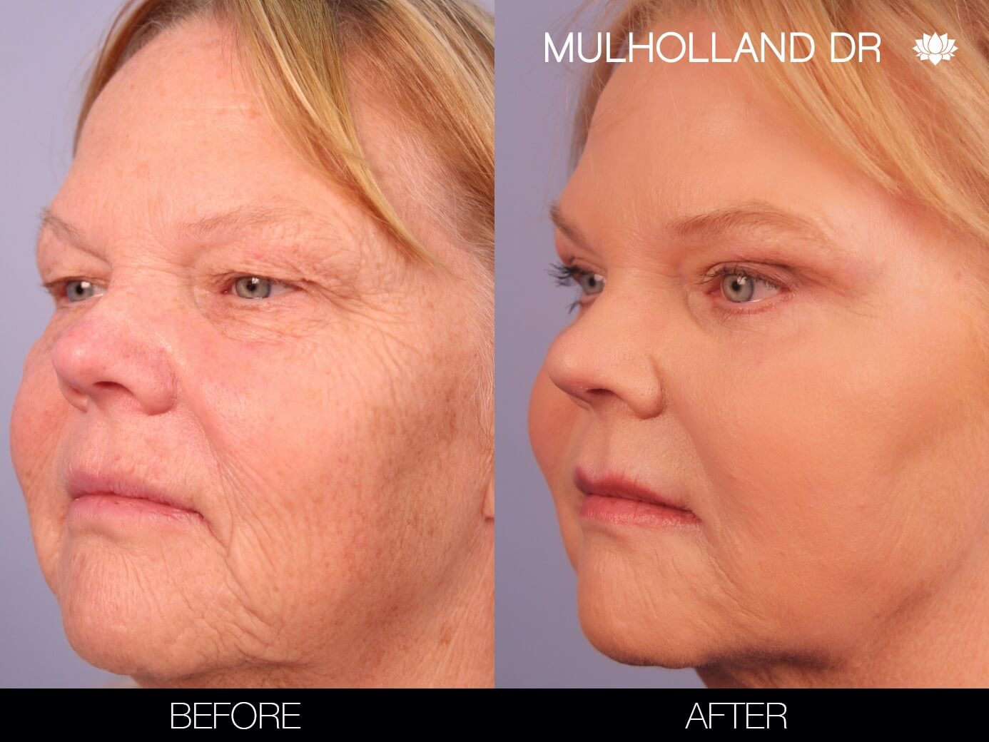 ThreadLift - Before and After Gallery – Photo 4