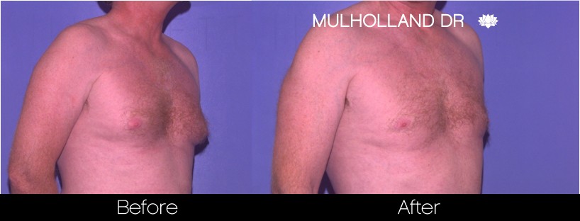 Male Liposuction - Before and After Gallery – Photo 4