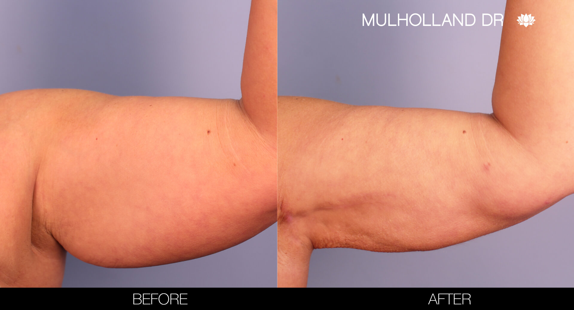 Arm Lift - Before and After Gallery – Photo 6