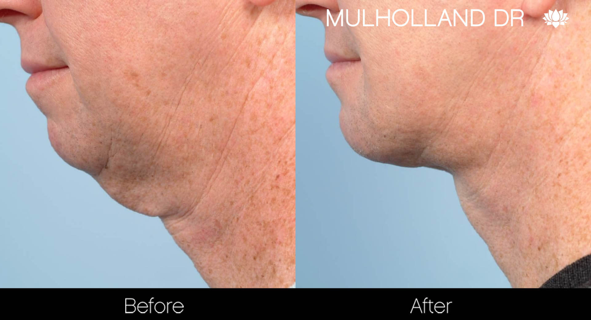 Facelift - Before and After Gallery – Photo 6