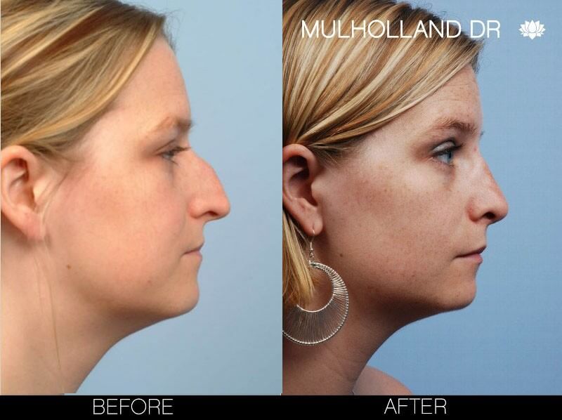 Rhinoplasty - Before and After Gallery – Photo 6