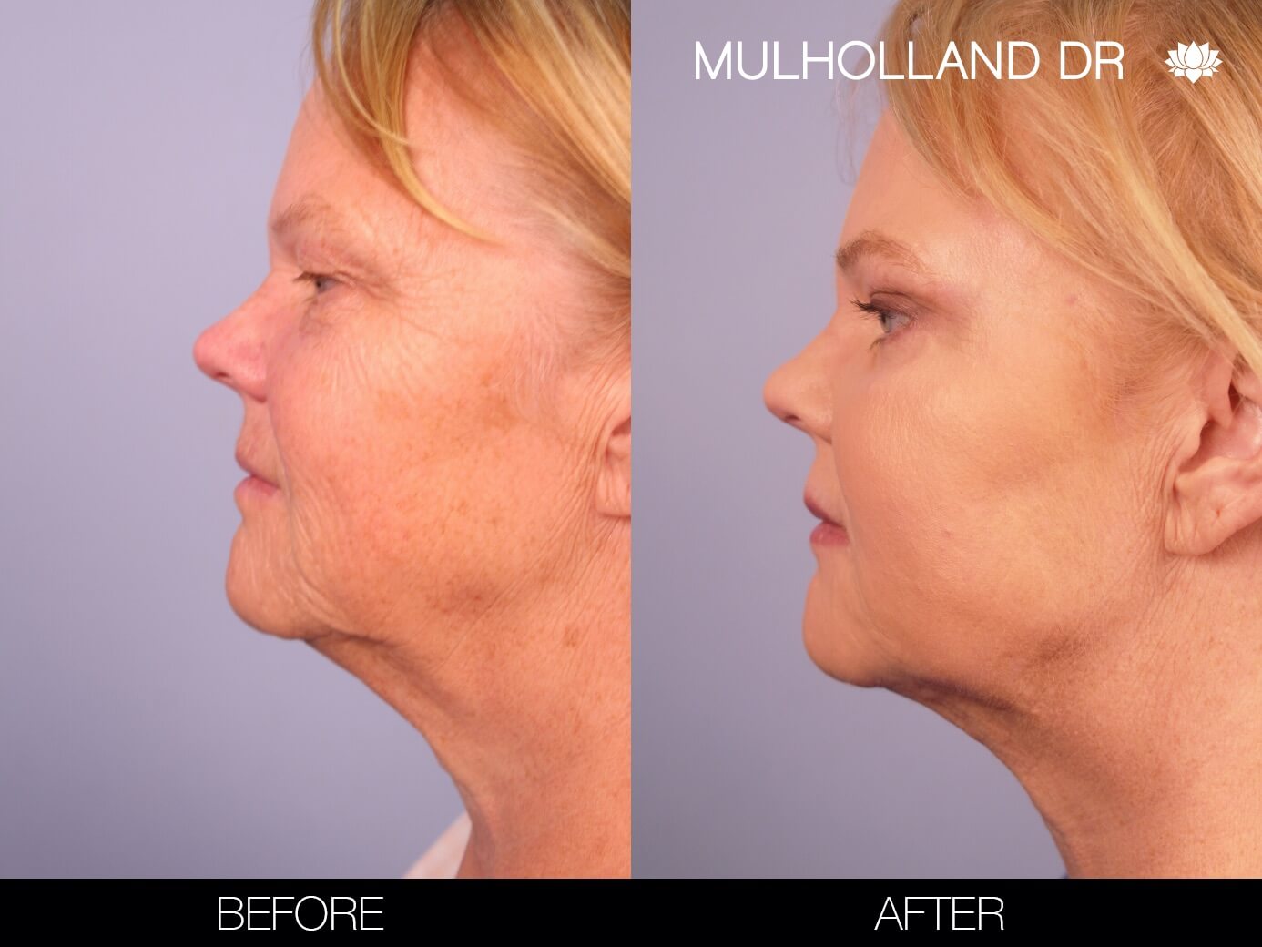 ThreadLift - Before and After Gallery – Photo 5