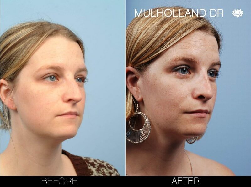 Rhinoplasty - Before and After Gallery – Photo 7