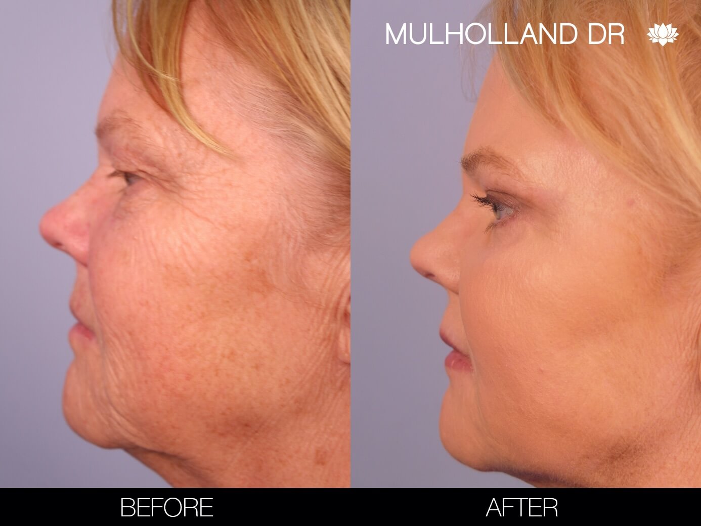 ThreadLift - Before and After Gallery – Photo 6