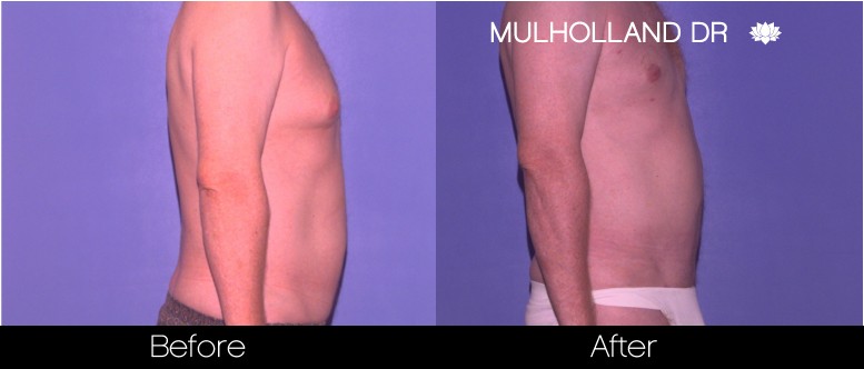 Male Liposuction - Before and After Gallery – Photo 7