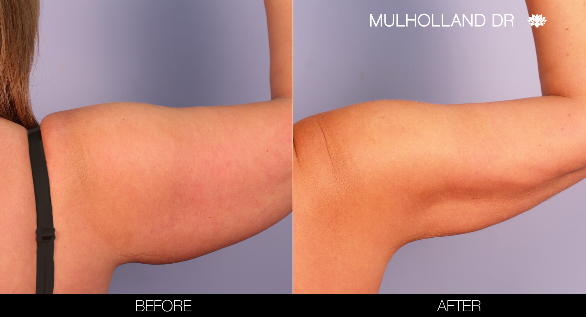 Arm Lift - Before and After Gallery – Photo 8