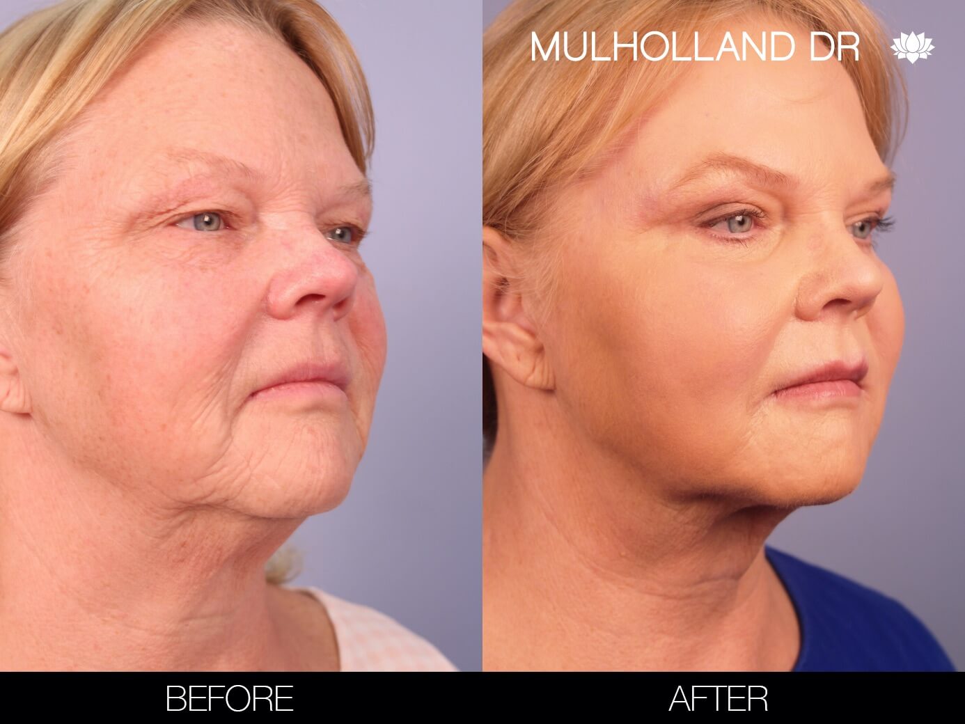 ThreadLift - Before and After Gallery – Photo 7