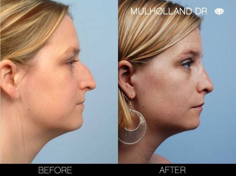 Rhinoplasty - Before and After Gallery – Photo 9