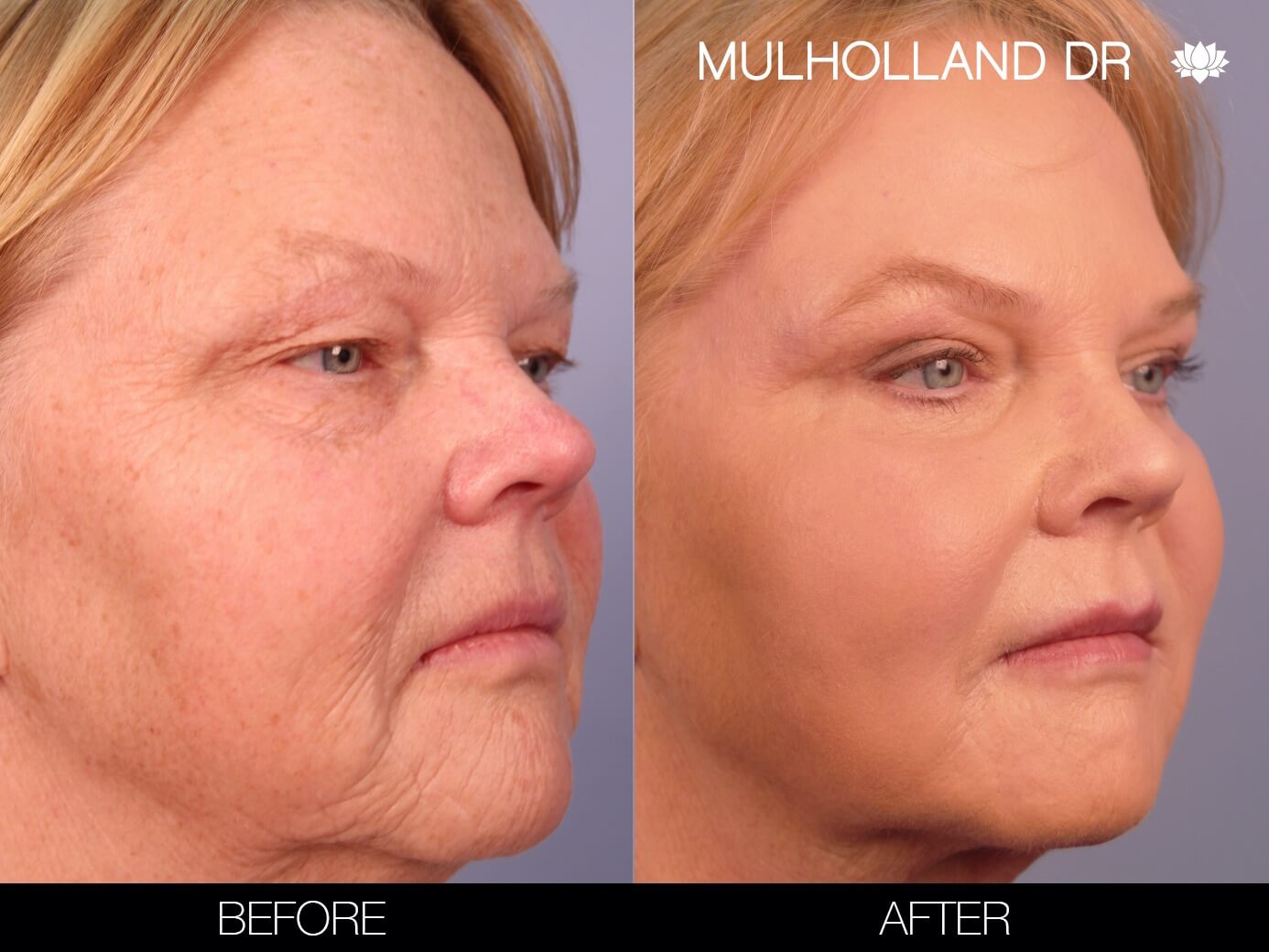 ThreadLift - Before and After Gallery – Photo 8